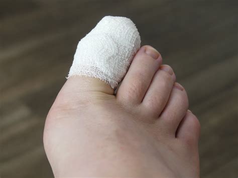 how to heal a stubbed toe
